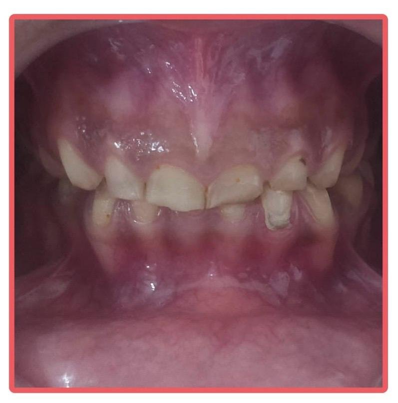 Dental Treatment Before