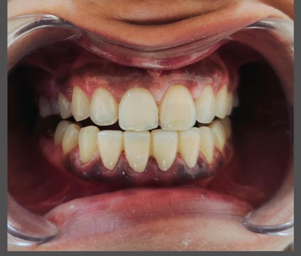 Dental Treatment After
