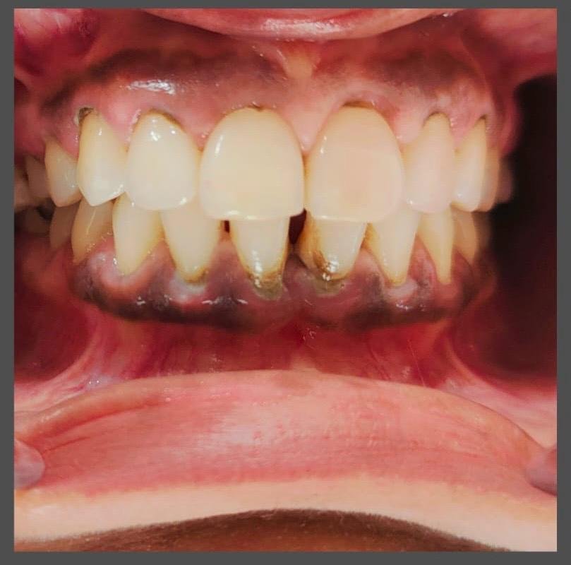 Dental Treatment Before